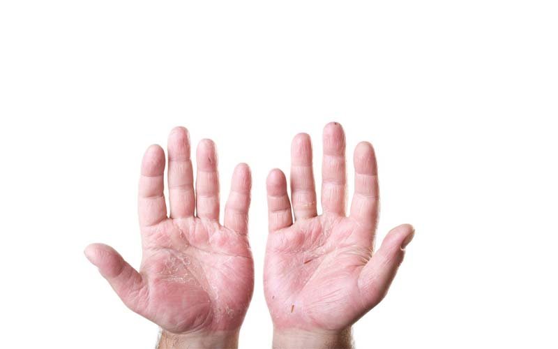 Foto: National Eczema Association