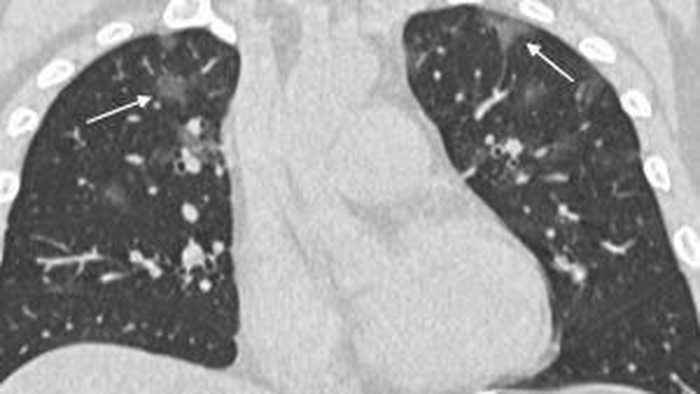 Beredar Gambar Kondisi Paru-paru yang Terinfeksi Virus Corona COVID-19 1 Paru-paru yang Terinfeksi Virus Corona