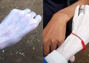 Kulit berubah jadi pucat seperti zombie. Foto: Odditycentral