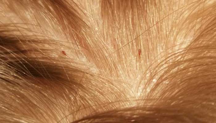 4 Tips Hilangkan Kutu Rambut Secara Alami - Islampos