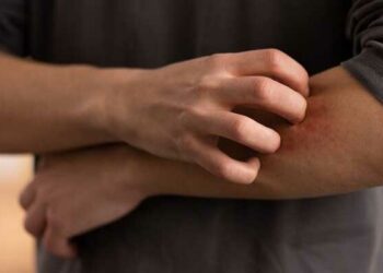 scabies